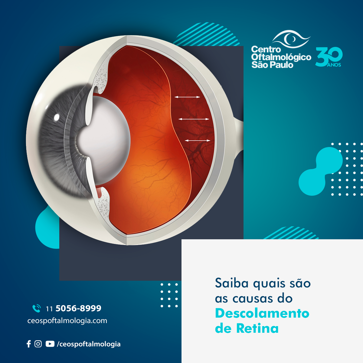 Saiba quais são as causas do descolamento de retina